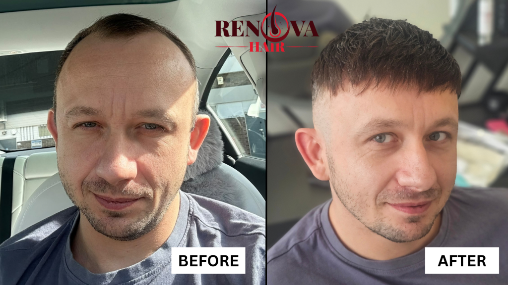 Male Pattern Hair Loss - Hair System before and after