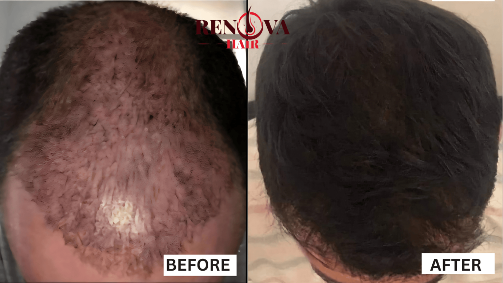 Two heads side by side showing the benefits of our trichology treatments