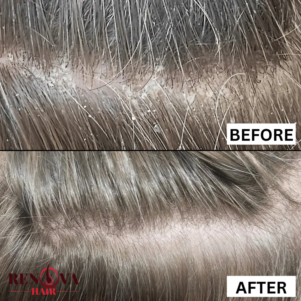 Trichological Treatments Leeds