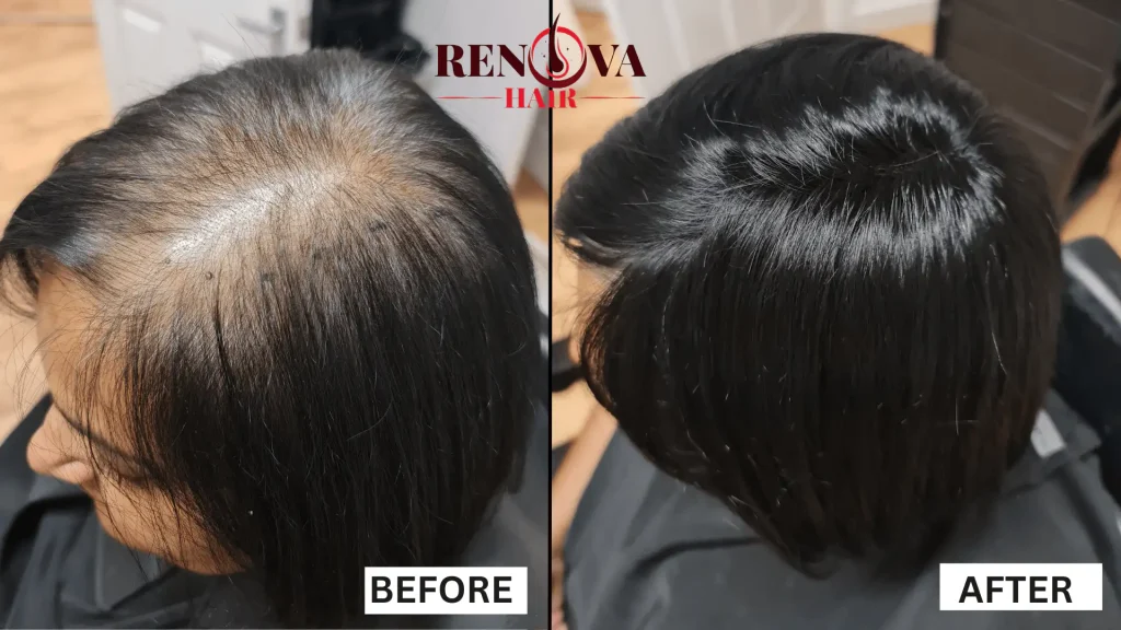 Scalp coverage improvement with mesh integration hair system in Leeds