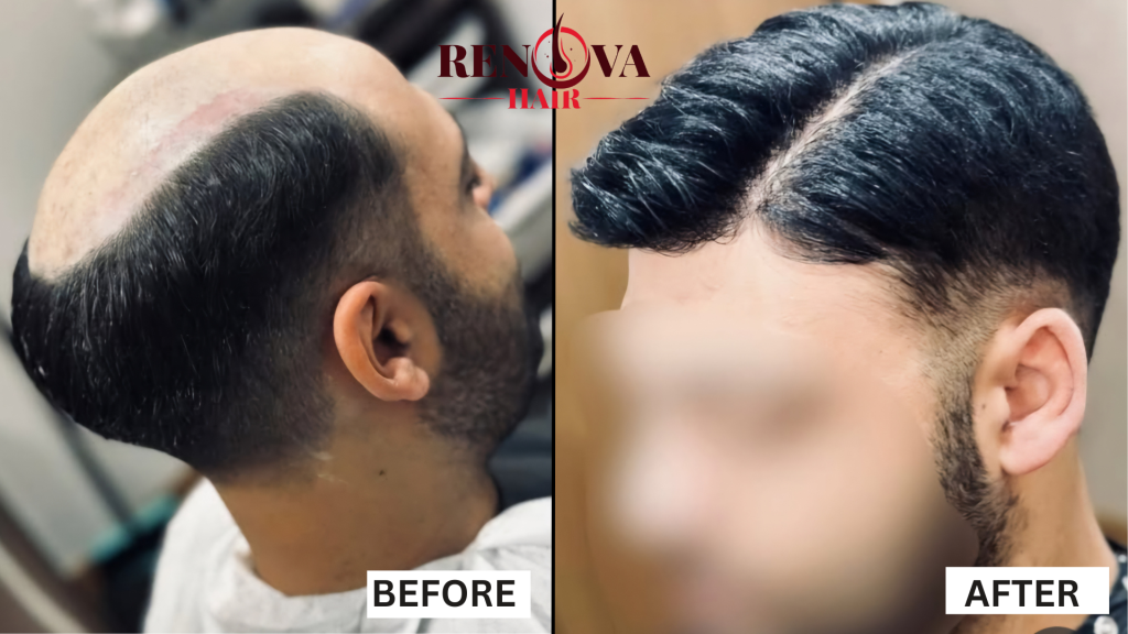 Before & After Hair System
