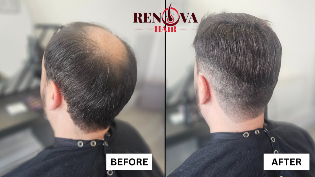 William Hair System before and after