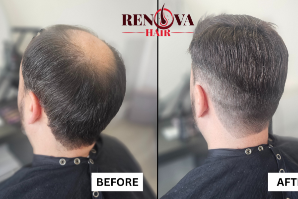 William Hair System before and after
