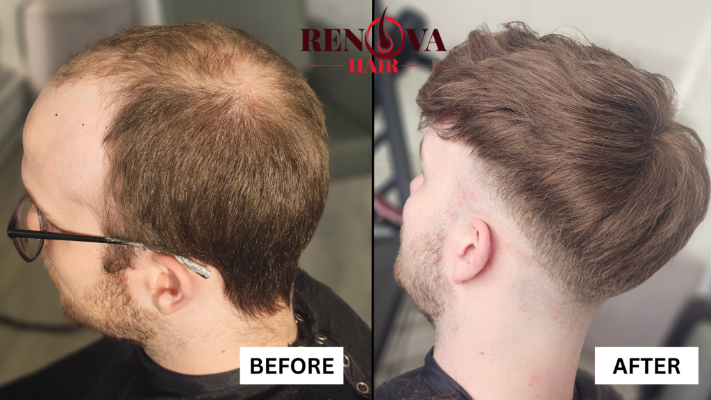 Before and After Hair System