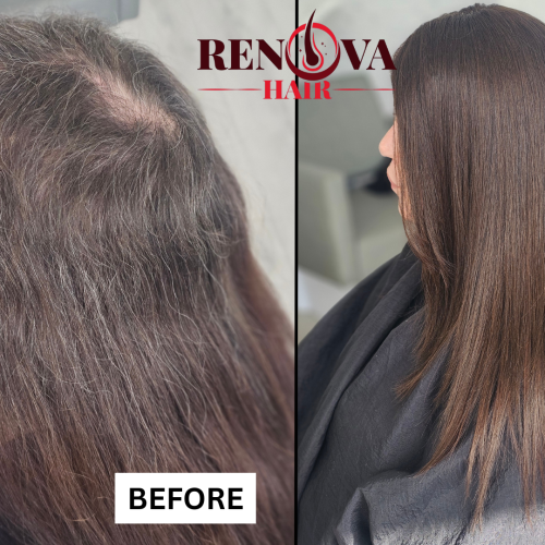 Trichotillomania Before and After Mesh Integration