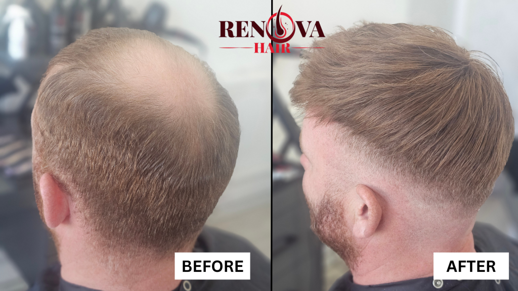 Hair System before and After