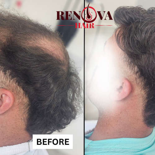 Hair System Before and After