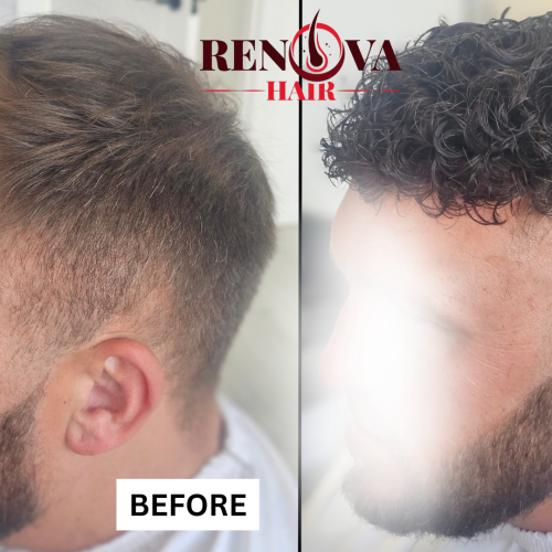 Before and After Hair System
