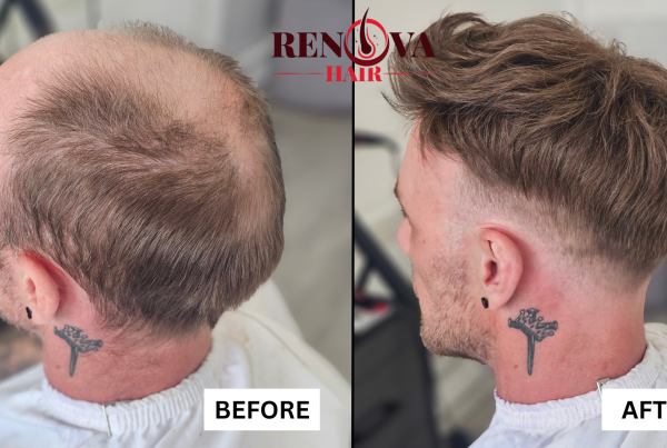 Before and After Hair System